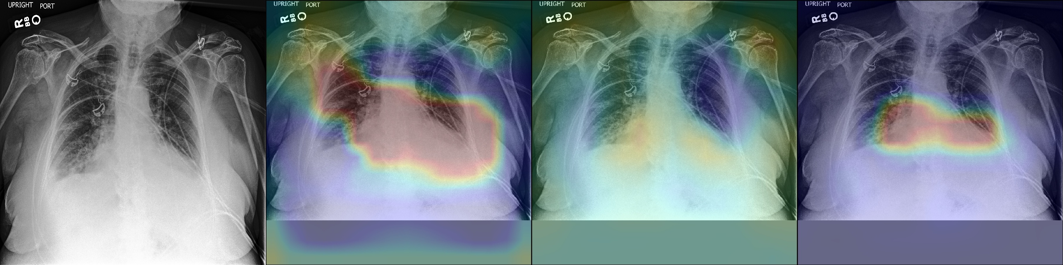 Cardiomegaly.jpg